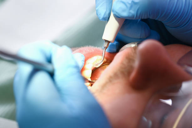 Best Emergency Dentist for Knocked-Out Tooth in Sturgis, SD
